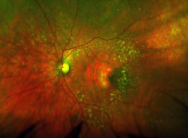 Photo of the back of the eye prior to gene therapy. The pale area in the centre is the macular degeneration. White spots known as drusen can also be seen. The optic nerve is to the left.
