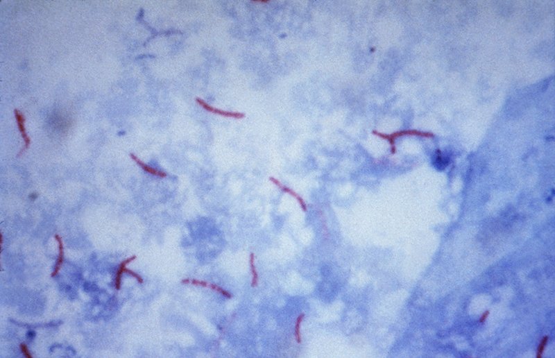 Photomicrograph revealing Mycobacterium tuberculosis bacteria using acid-fast Ziehl-Neelsen stain; Magnified 1000x - Photo: CDC/Dr. George P. Kubica