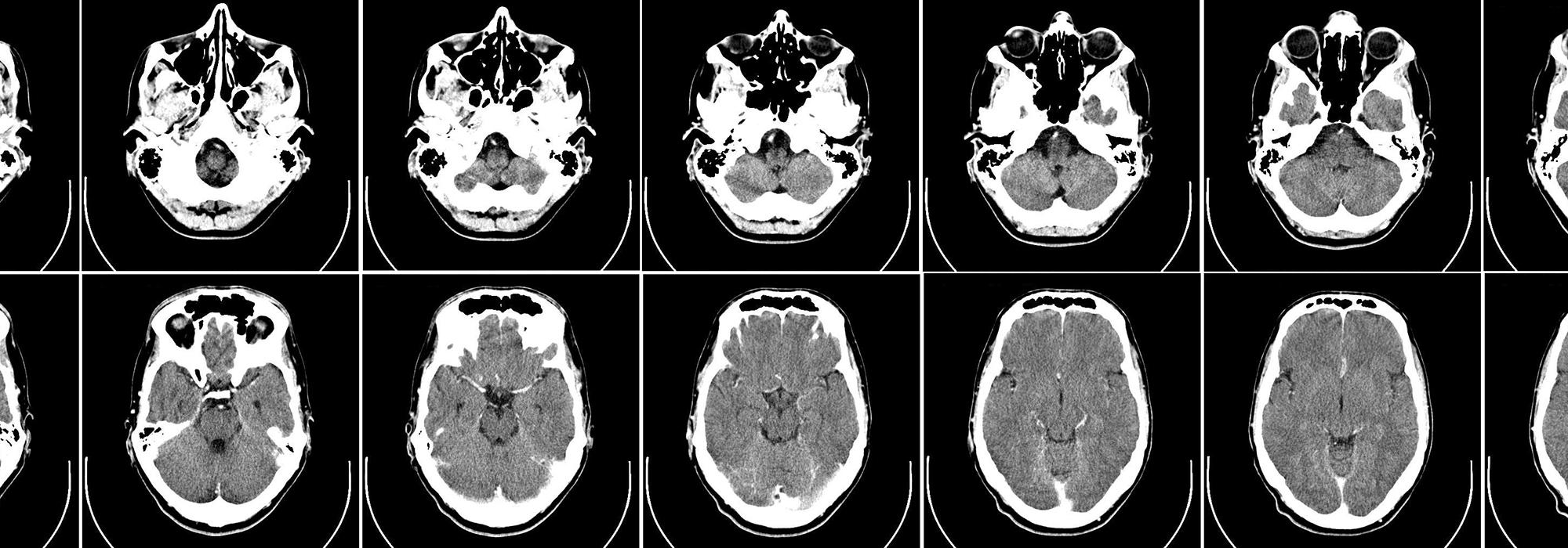 Computed tomography of the human brain