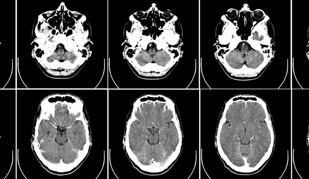 Computed tomography of the human brain